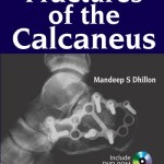 Fractures of the Calcaneus