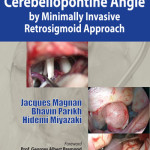 Functional Surgery of Cerebellopontine Angle by Minimally Invasive Retrosigmoid Approach