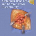 Treatment of Acetabular Bone Loss and Chronic Pelvic Discontinuity – E-Book